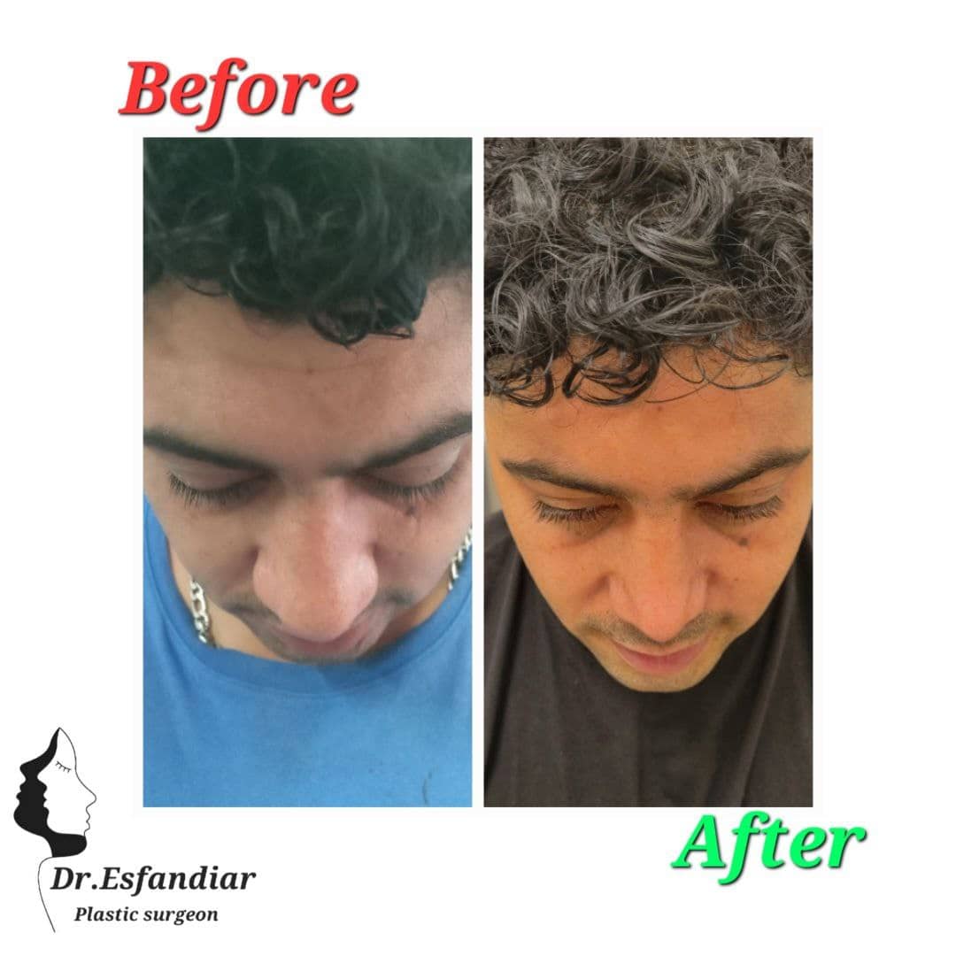 دکتر علی اصغر اسفندیار فوق تخصص جراحی زیبائی ترمیمی عمل زیبایی بینی جراحی پلک بالا بینی استخوانی بینی گوشتی جراحی زیبایی بینی