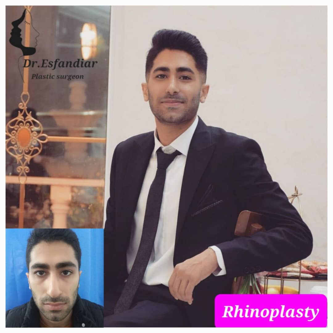 دکتر علی اصغر اسفندیار فوق تخصص جراحی زیبائی ترمیمی عمل زیبایی بینی جراحی پلک بالا بینی استخوانی بینی گوشتی جراحی زیبایی بینی
