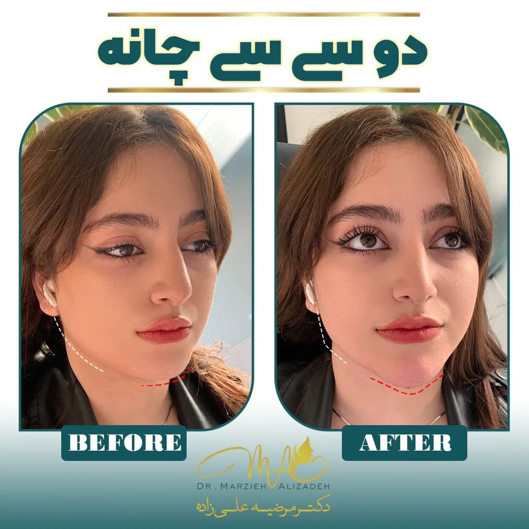 دکتر مرضیه علیزاده کانتورینگ صورت  تزریق چانه  ژل چانه  زاویه فک  مادلینگ صورت  ساکشن غبغب