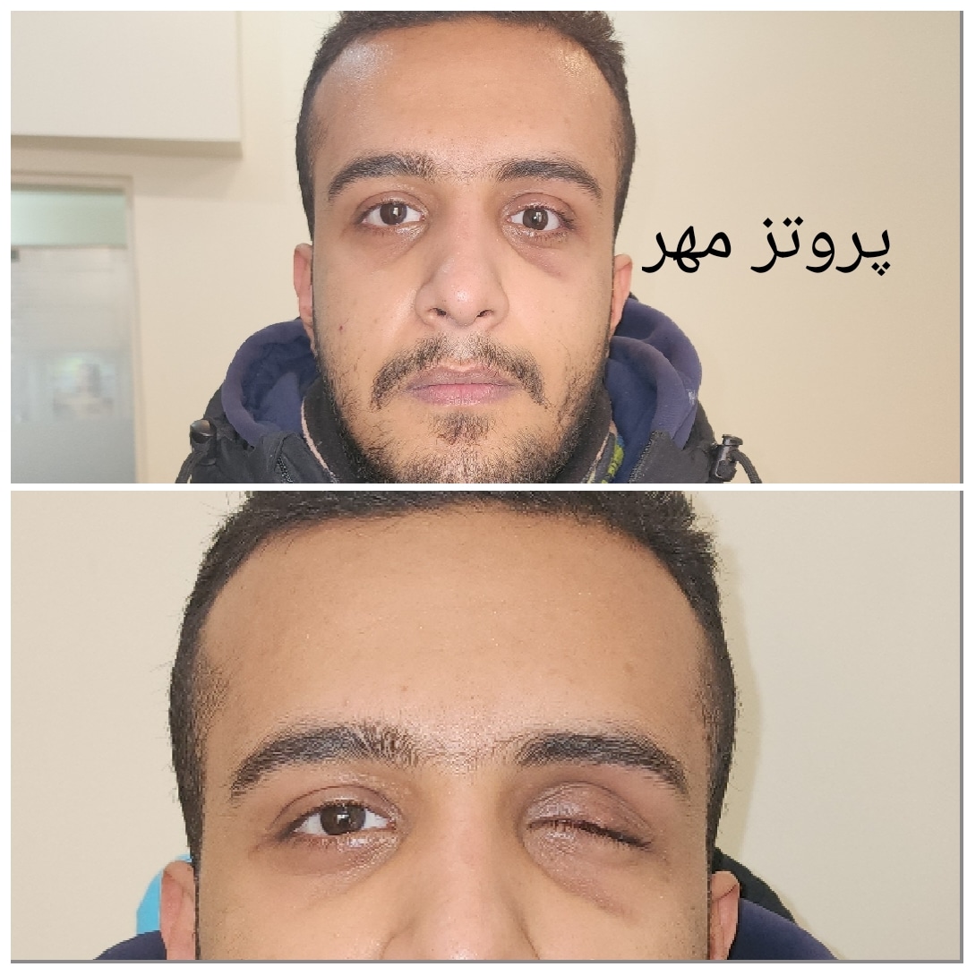پروتز چشم مهر تهران پروتز اسکلراشل پروتزیست  آناپلاستولوژي  چشم پزشکی  چشم مصنوعی  لنز چشم  جراحی زیبایی  پلک