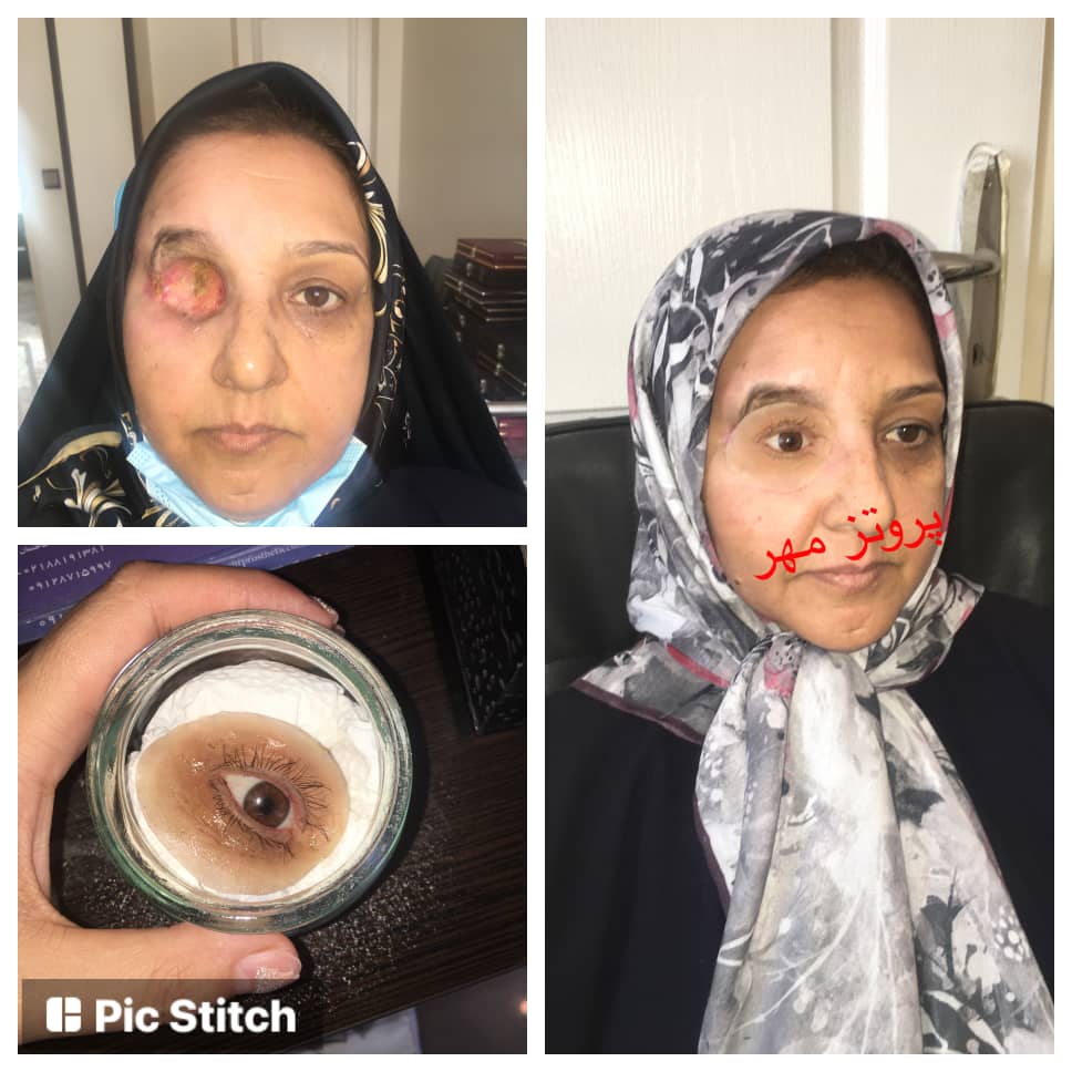 پروتز چشم مهر تهران پروتز اسکلراشل پروتزیست  آناپلاستولوژي  چشمپزشکی  چشم مصنوعی  لنز چشم  جراحی زیبایی پلک